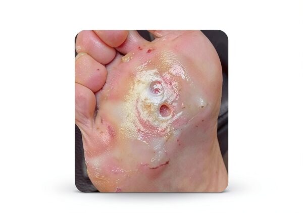 CARBOU Super Absorbent Wound Dressing Non Adhesive-5