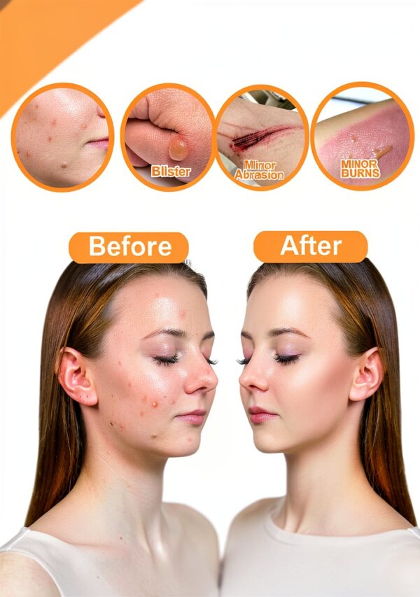 YIUERTEO Hydrocolloid Roll Wound Dressing Medical Grade-4